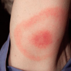 Bullseye Lyme Disease tick bite 04-18-17